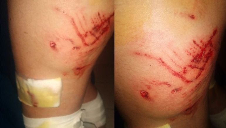 Una jauría atacó a una nena de 14 años y casi la desgarran: Está viva de milagro