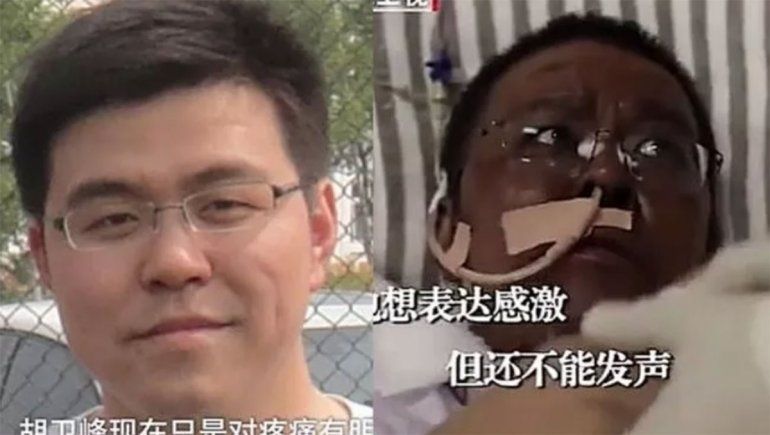 Dos médicos chinos sufrieron un cambio de color de piel luego recuperarse de coronavirus