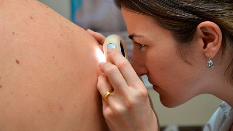 Otorgan turnos gratuitos con dermatólogos para detectar una rara enfermedad