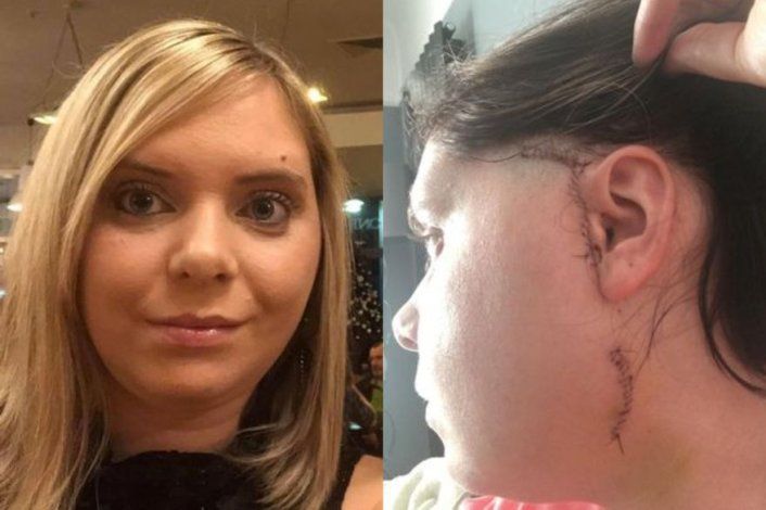 Holly Strevens, la mujer que es viral por dislocarse la mandíbula comiendo una hamburguesa doble.