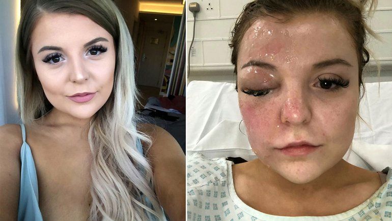 Puso dos huevos en el microondas y casi queda ciega