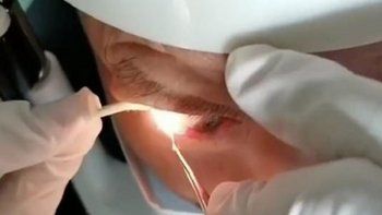 a un chino le sacaron 20 gusanos vivos de un ojo a un chino le sacaron 20 gusanos vivos de un ojo