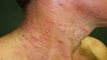 El boletín epidemiológico nacional reportó un exponencial aumento de casos de sífilis en Neuquén. El boletín epidemiológico nacional reportó un exponencial aumento de casos de sífilis en Neuquén.