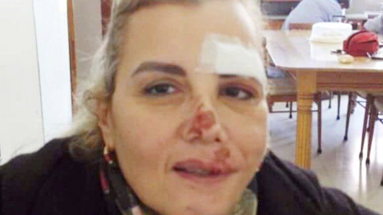 Sandra Biló con las marcas por la golpiza que le dieron los ladrones.