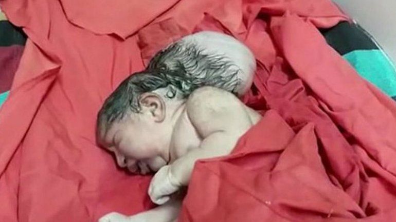 Conmoción por una beba que nació con tres cabezas