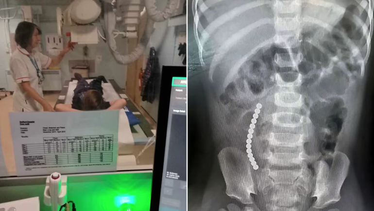 Operaron de urgencia a un nene de 12 años por un reto viral de TikTok: qué hizo