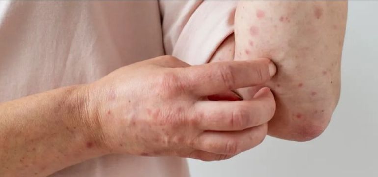 A pesar de estas cifras, los especialistas advierten que podrían encontrarse más casos en los próximos días. A pesar de estas cifras, los especialistas advierten que podrían encontrarse más casos en los próximos días.