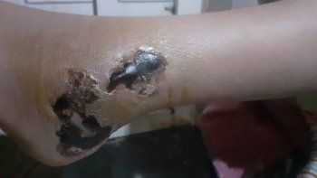 dio positivo en covid y tuvo que luchar para que curaran a su hija accidentada dio positivo en covid y tuvo que luchar para que curaran a su hija accidentada