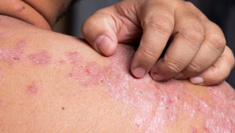 Dermatitis atópica, la enfermedad de alto impacto emocional