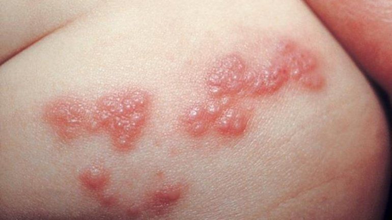 Covid-19: seis pacientes desarrollan herpes zóster en Israel después de vacunarse