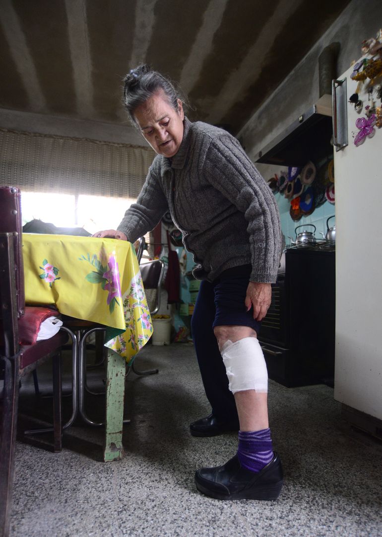 María Olguín muestra su herida en la pierna. Se salvó de milagro porque su hijo la asistió cunado pasaba con su auto.