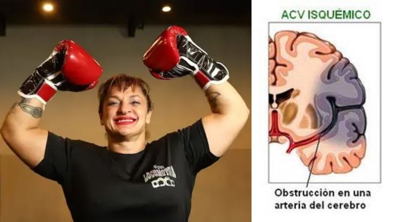 ¿Qué es un ACV isquémico? La enfermedad silenciosa que terminó con la vida de la Locomotora Oliveras
