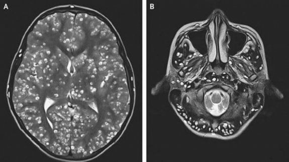 Le dolía la cabeza y tenía el cerebro lleno de larvas