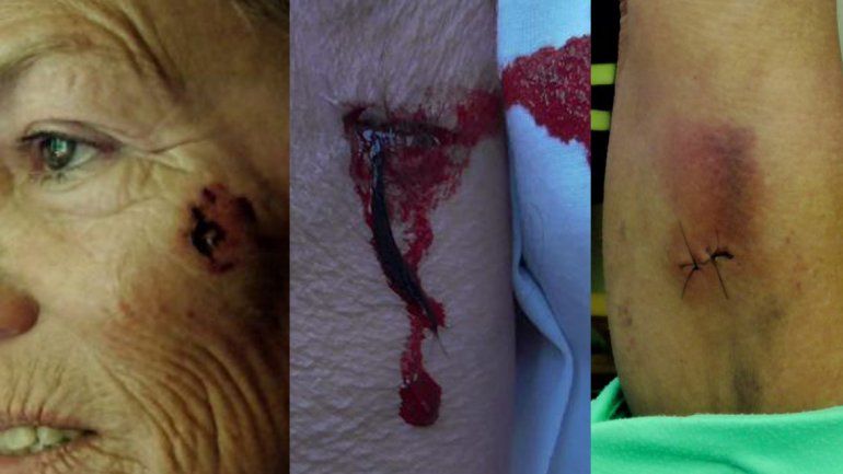 Una mujer fue brutalmente atacada por dos perros de su vecina