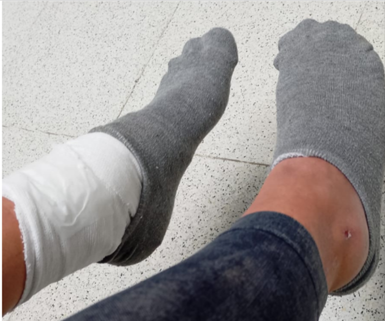 Por los esguinces que le provocó el choque con su moto, Carolina no puede caminar. Por los esguinces que le provocó el choque con su moto, Carolina no puede caminar. 