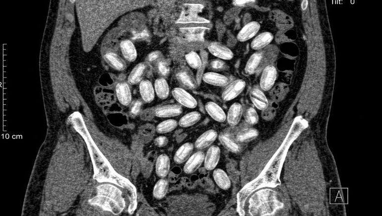 La tomografía mostró cápsulas de cocaína ingeridas por los pasajeros, distribuidas en el sistema digestivo. La tomografía mostró cápsulas de cocaína ingeridas por los pasajeros, distribuidas en el sistema digestivo.