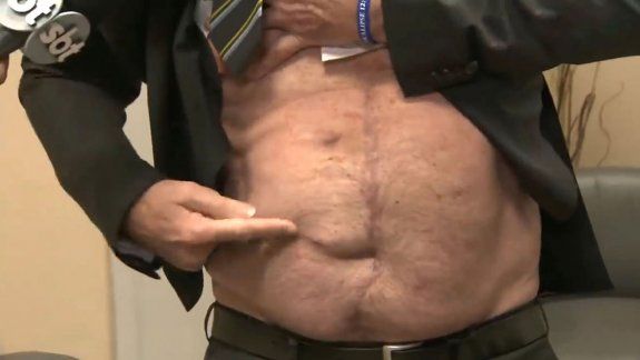 Bolsonaro mostró la cicatriz para callar las especulaciones