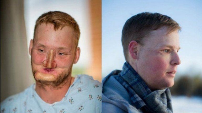 El nuevo rostro de Sandness. El donante también tenía 21 y se suicidó.