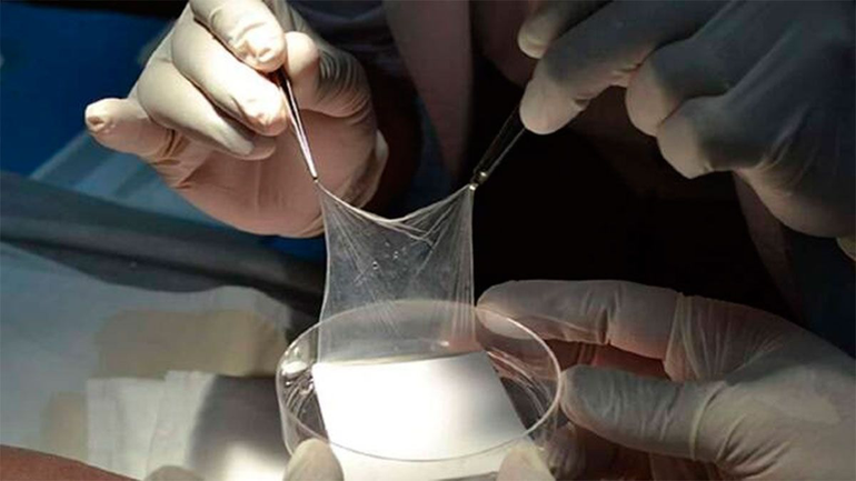 Parches de placenta para reparar daños en la piel