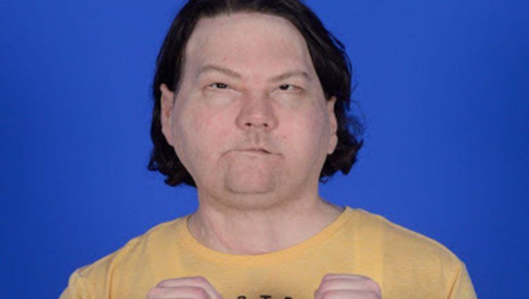 Un joven recibió el primer trasplante de cara y manos exitoso