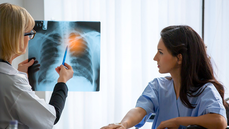 El cáncer de pulmón mató a más de 10 mil argentinos en 2020