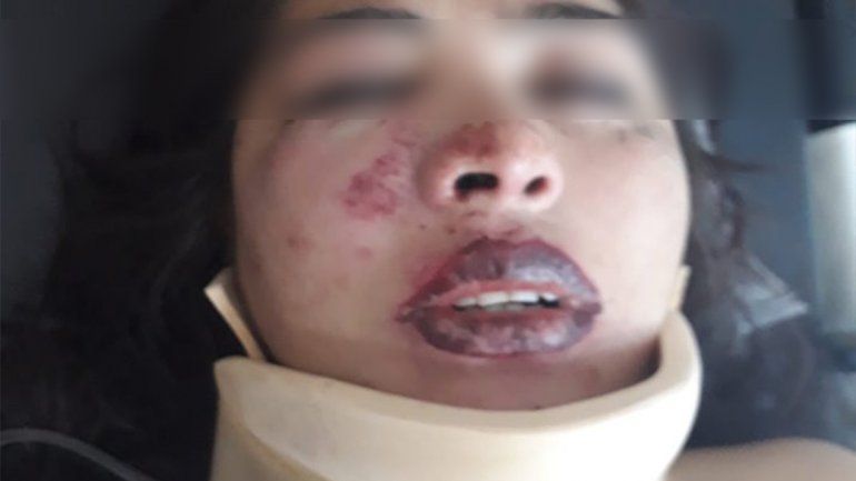 Le desfiguraron la cara a la salida de un boliche de Bariloche