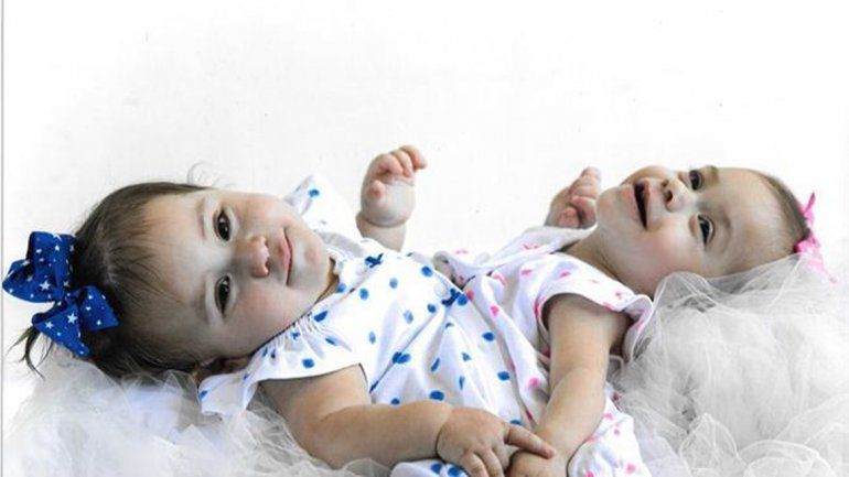 Erika y Eva Sandoval estaban unidas por la vejiga