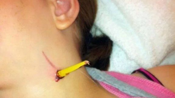 Se clavó un lápiz en el cuello cuando se cayó en la escuela