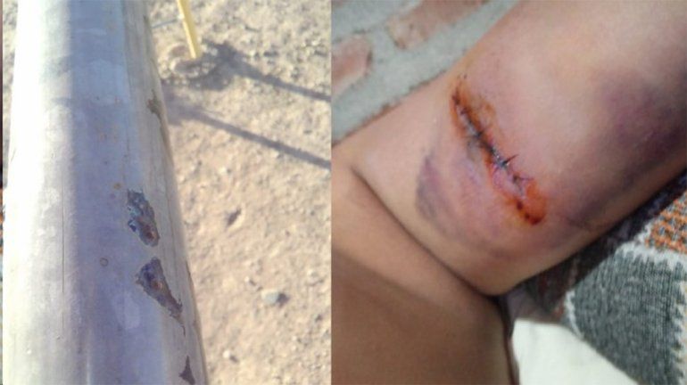 Se cortó la mano en los juegos de una plaza abandonada