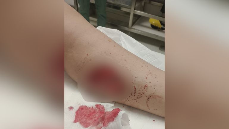 La mujer presenta una lesión considerable producto de la mordedura de los perros.