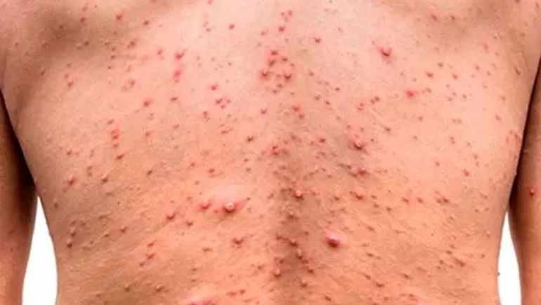 Durante el 2023 también se registraron casos de la viruela símica en Europa. Durante el 2023 también se registraron casos de la viruela símica en Europa.