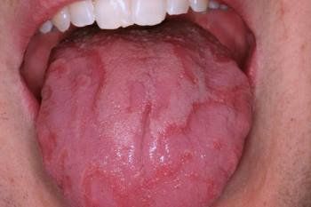 COVID-19: la lengua podría ser otro indicador de contagio