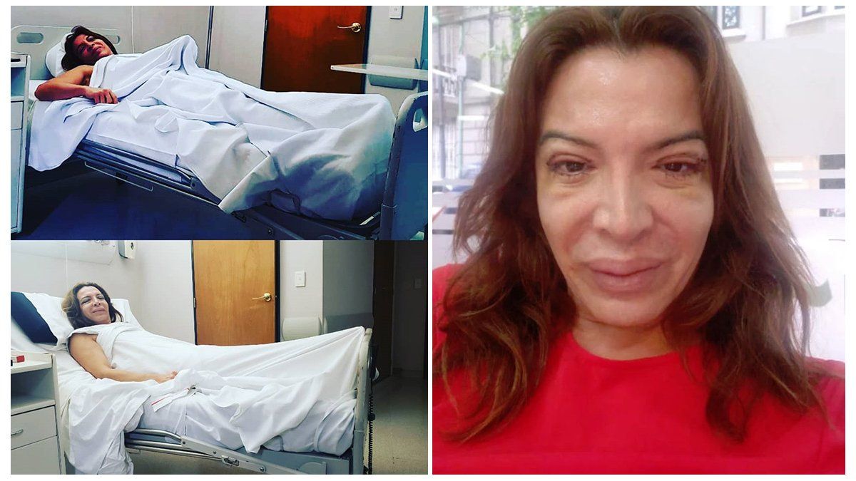 Lizy Tagliani Mostro Su Nueva Cara Tras La Cirugia