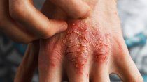 nuevos tratamientos traen alivio a los que padecen dermatitis atopica severa