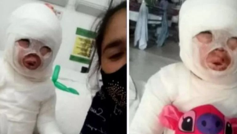 Dramático: tropezó y le volcó aceite hirviendo a una nena de 3 años