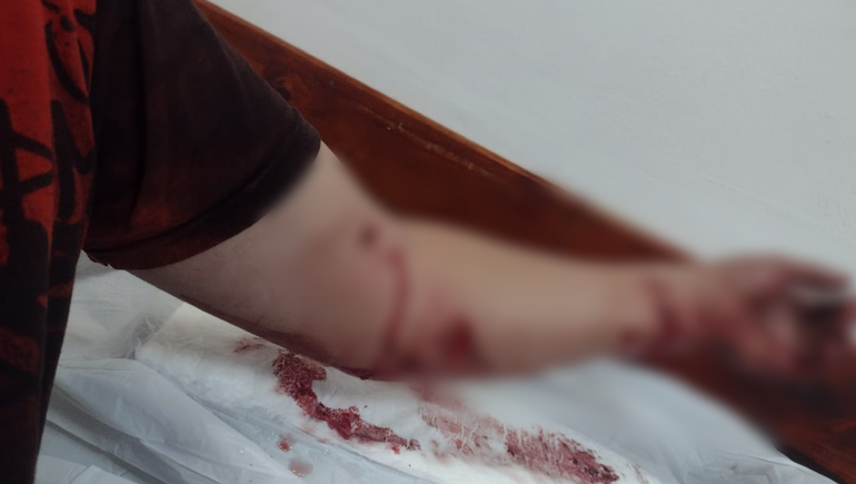 Dramático ataque de pitbulls en Valentina Norte Rural: atacaron a una pareja y a un nene de 5