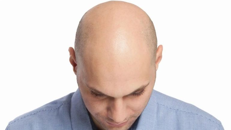 n este día especial, se comparten frases, memes y homenajes que resaltan la confianza y el estilo de las personas calvas. n este día especial, se comparten frases, memes y homenajes que resaltan la confianza y el estilo de las personas calvas.