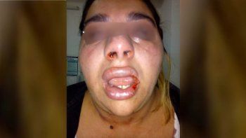 una joven de cinco saltos denuncio que su ex pareja le desfiguro la cara golpes una joven de cinco saltos denuncio que su ex pareja le desfiguro la cara golpes