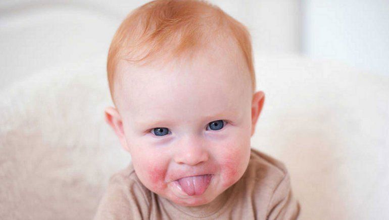 Un medicamento que alivia a los que sufren piel atópica