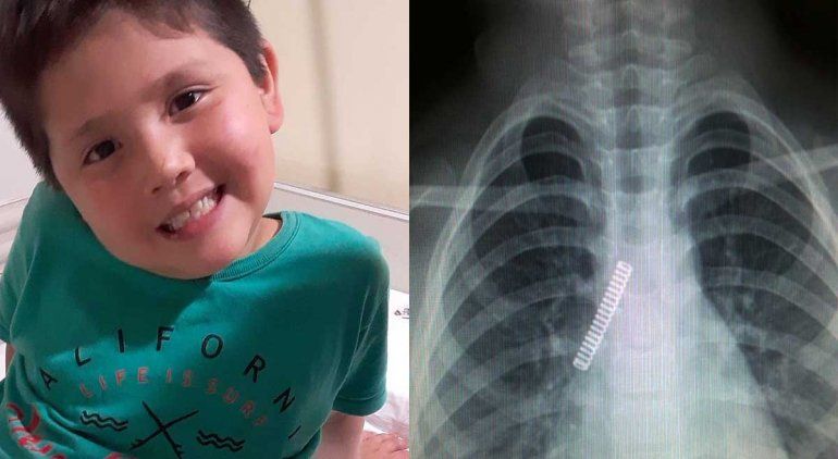 Cipo: nene se tragó un resorte y se le fue a los pulmones