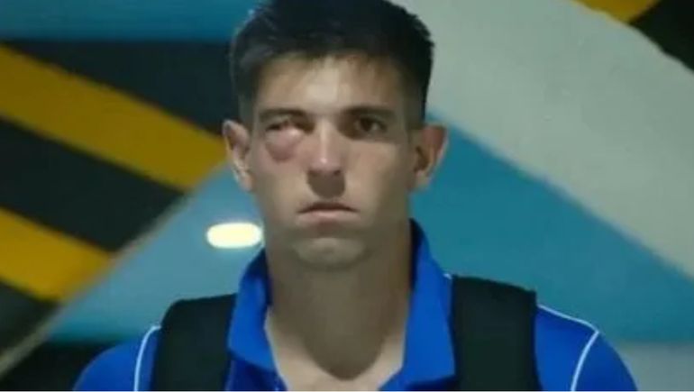 Tremendo: cómo le quedó la cara al arquero de San Lorenzo después de sufrir una fractura en el rostro