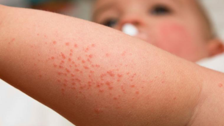 Trastornos de la piel: todo sobre la dermatitis atópica