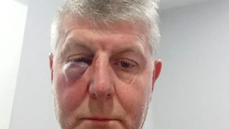 Escándalo en La Pampa: un árbitro expulsó a un jugador y le rompió la nariz y un ojo de una trompada.