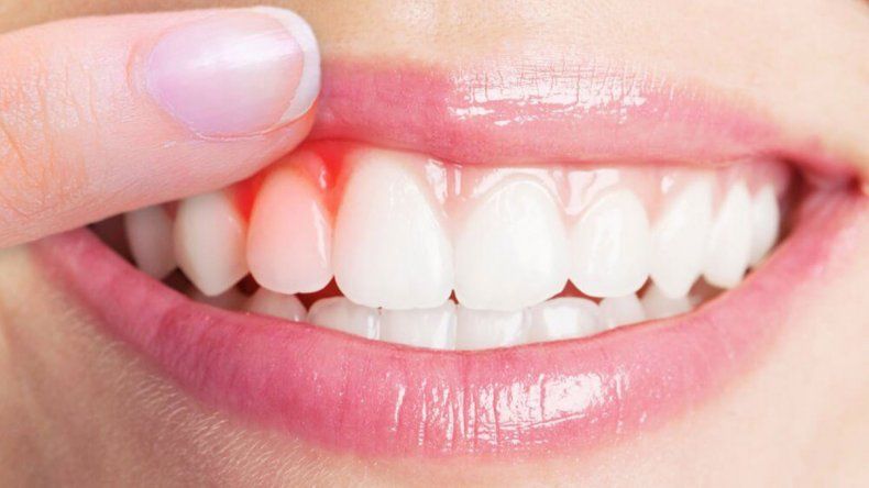 La vitamina C y el sangrado de encías