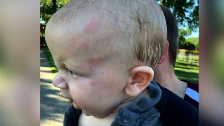 Un bebé sufrió hemorragia cerebral por una cachetada