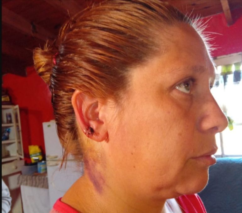 Johana Díaz y la marca que le dejó el disparo que le entró por la nuca: según el fiscal, se salvó porque se agachó justo a tiempo. Johana Díaz y la marca que le dejó el disparo que le entró por la nuca: según el fiscal, se salvó porque se agachó justo a tiempo.