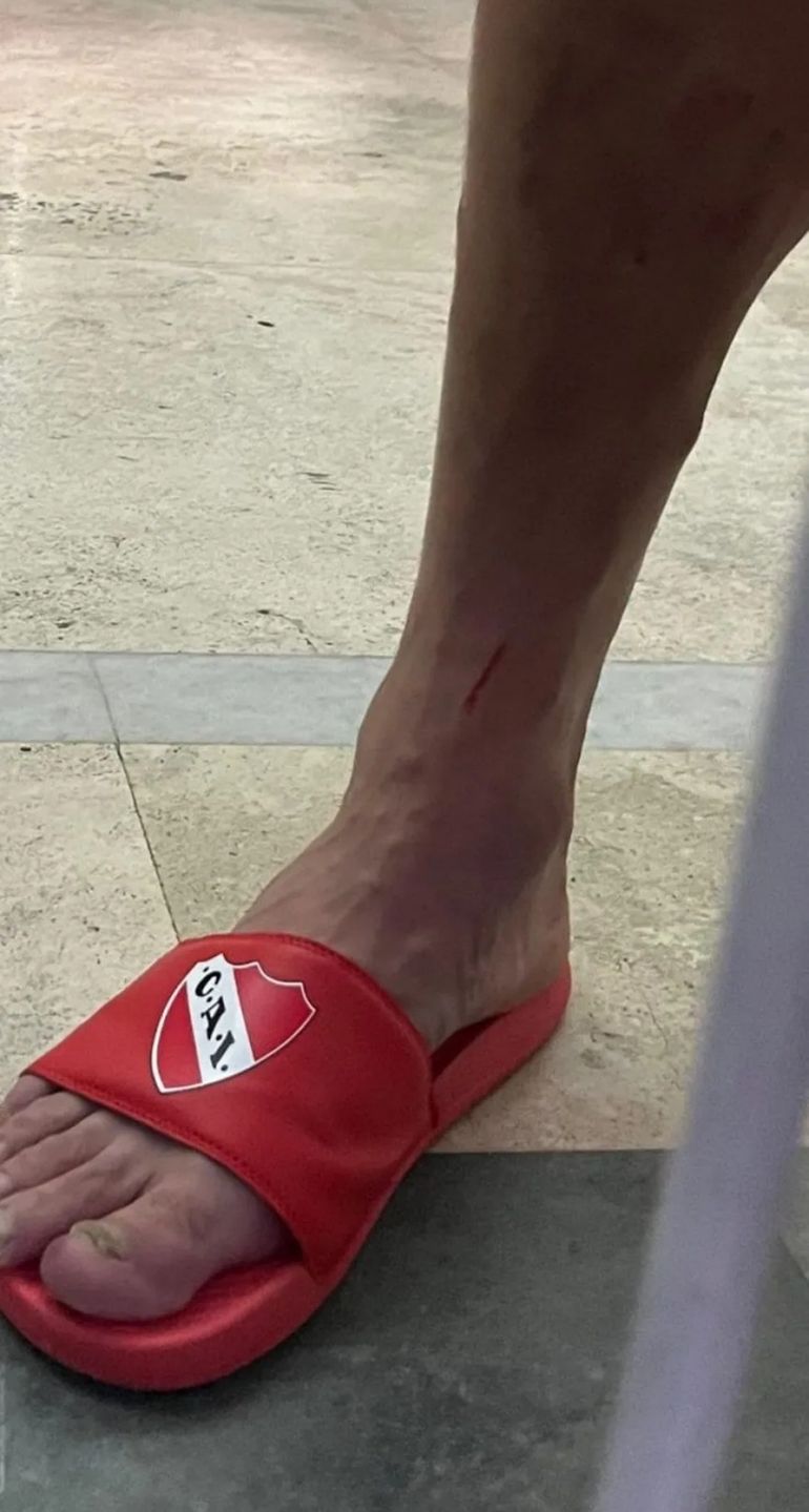 El capitán de Independiente mostró cómo le quedó la pierna El capitán de Independiente mostró cómo le quedó la pierna
