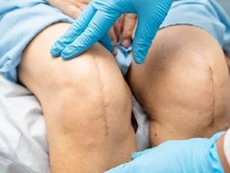 El tornillo utilizado para cirugías de rodilla fue prohibido por ANMAT por presentar irregularidades en su registro. El tornillo utilizado para cirugías de rodilla fue prohibido por ANMAT por presentar irregularidades en su registro.