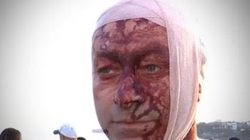 sobrevivio al ataque de hamas y ahora fue herido en un atentado antisemita en australia sobrevivio al ataque de hamas y ahora fue herido en un atentado antisemita en australia