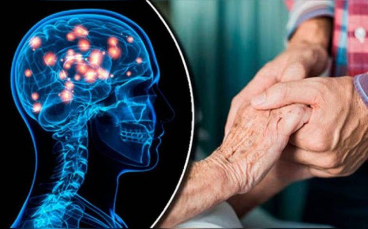 La mayoría de los pacientes desarrolla desarrolla la enfermedad de Huntington entre los 35 y los 50 años.